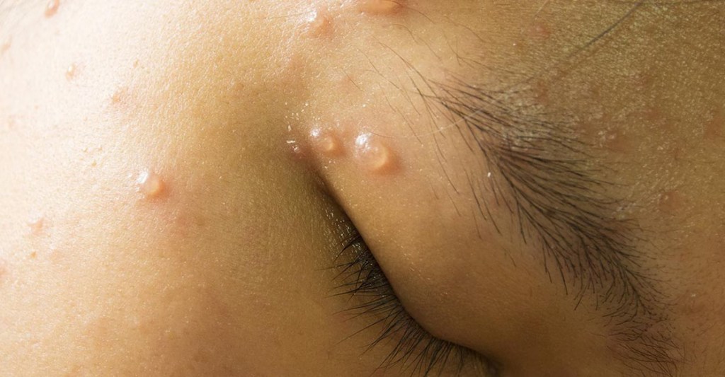 วัคซีนอีสุกอีใสในเด็ก: จำเป็นหรือไม่? ราคาเท่าไหร่?