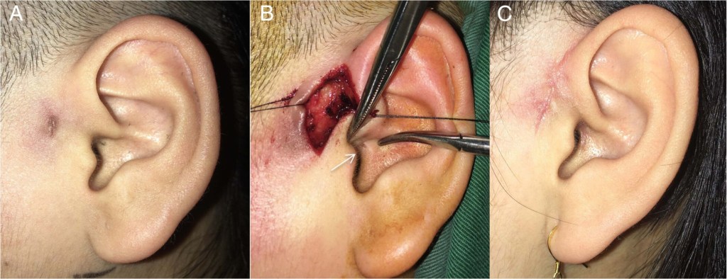 รูข้างใบหูเล็กๆ ภาพจาก  https://onlinelibrary.wiley.com/doi/full/10.1002/lary.31378