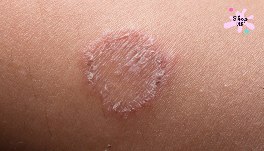 “กลาก-เกลื้อน-จุดด่างขาว” บนหน้าและลำตัว โรคนี้เป็นแล้วต้องทายาอะไร?