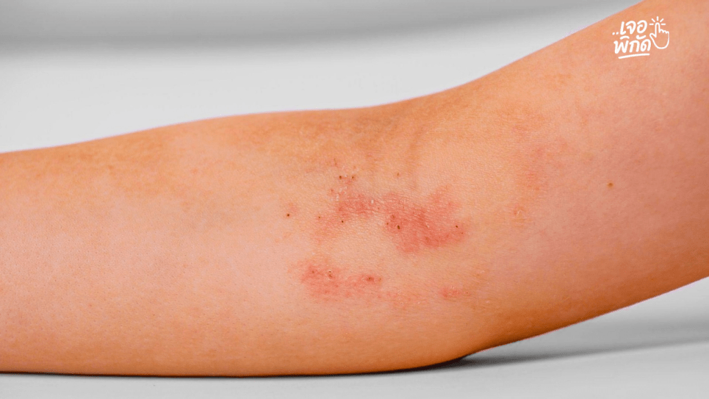 เจาะลึกโรคผื่นภูมิแพ้ผิวหนัง (Atopic Dermatitis) สาเหตุ วิธีรักษา และการดูแลตัวเองให้หายขาด
